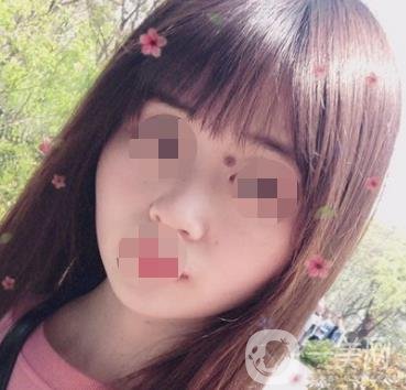 贛州附屬醫(yī)院整形美容科價格表及點痣案例公布，速覽