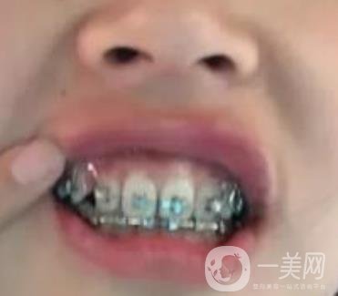 龍崗中心醫(yī)院整牙多少錢？?jī)r(jià)格表2020收費(fèi)明細(xì)公開一覽