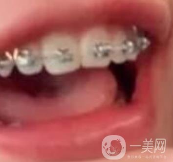 龍崗中心醫(yī)院整牙多少錢？?jī)r(jià)格表2020收費(fèi)明細(xì)公開一覽