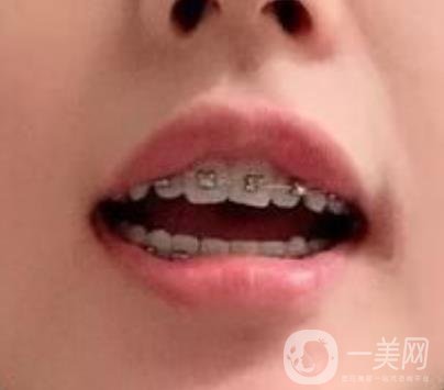 龍崗中心醫(yī)院整牙多少錢？?jī)r(jià)格表2020收費(fèi)明細(xì)公開一覽