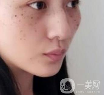 安醫(yī)一附院整形外科價(jià)格表2020版，還有激光祛斑案例