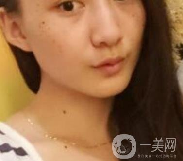 安醫(yī)一附院整形外科價(jià)格表2020版，還有激光祛斑案例