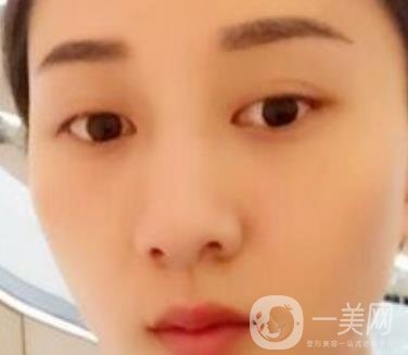 安醫(yī)一附院整形外科價(jià)格表2020版，還有激光祛斑案例