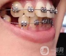 北京市海淀醫(yī)院口腔科價格表2020更新，附牙齒矯正案例