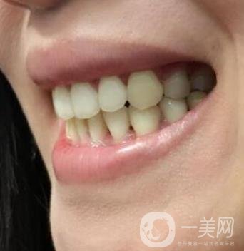 北京市海淀醫(yī)院口腔科價格表2020更新，附牙齒矯正案例