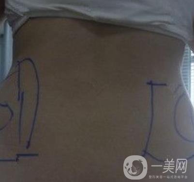 襄陽市第一人民醫(yī)院整形美容科吸脂瘦肚子多少錢？價格表整形日記一覽