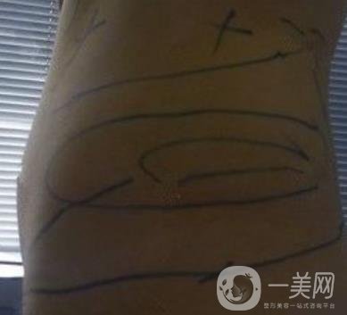 襄陽市第一人民醫(yī)院整形美容科吸脂瘦肚子多少錢？價格表整形日記一覽