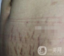 陽煤集團總醫(yī)院整形美容科祛妊娠紋恢復記錄，內(nèi)附價格表