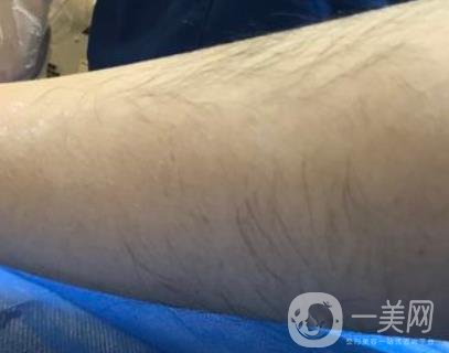 山東省立醫(yī)院整形科激光脫毛*果好嗎?價格收費(fèi)標(biāo)準(zhǔn)表一覽