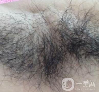 山東省立醫(yī)院整形科激光脫毛*果好嗎?價格收費(fèi)標(biāo)準(zhǔn)表一覽