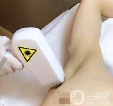 山東省立醫(yī)院整形科激光脫毛*果好嗎?價格收費(fèi)標(biāo)準(zhǔn)表一覽