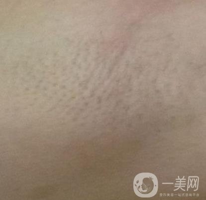 山東省立醫(yī)院整形科激光脫毛*果好嗎?價格收費(fèi)標(biāo)準(zhǔn)表一覽