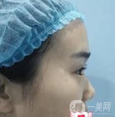 上海市第一人民醫(yī)院整形科隆鼻大概要多少錢?附價格明細一覽表