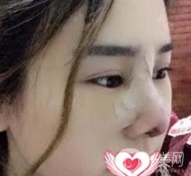 上海市第一人民醫(yī)院整形科隆鼻大概要多少錢?附價格明細一覽表