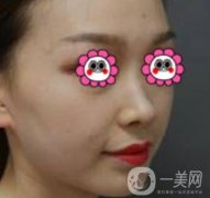 沈陽杏林崔昌墉做鼻子怎么樣？2020整形價格表一覽