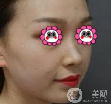 沈陽(yáng)杏林崔昌墉做鼻子怎么樣?2020整形價(jià)格表一覽