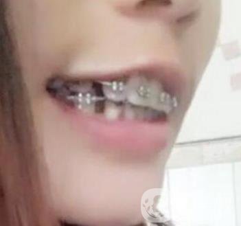 桂林美奧口腔醫(yī)院價格表全新版，附牙齒矯正案例