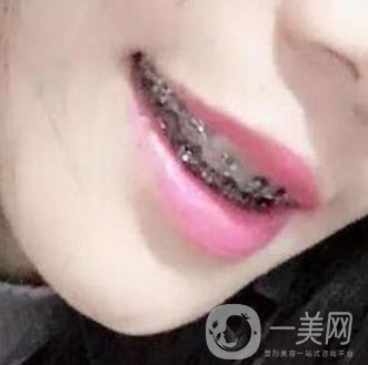 桂林美奧口腔醫(yī)院價格表全新版，附牙齒矯正案例