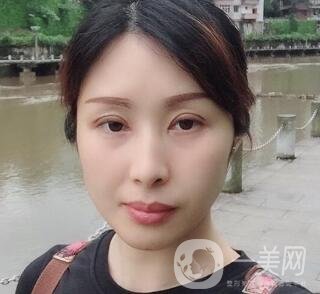 沈陽軍區(qū)總醫(yī)院整形外科價格表，附雙眼皮真實案例