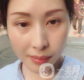 沈陽軍區(qū)總醫(yī)院整形外科價格表，附雙眼皮真實案例