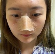 重慶新橋醫(yī)院整形科價格表，隆鼻案例分享