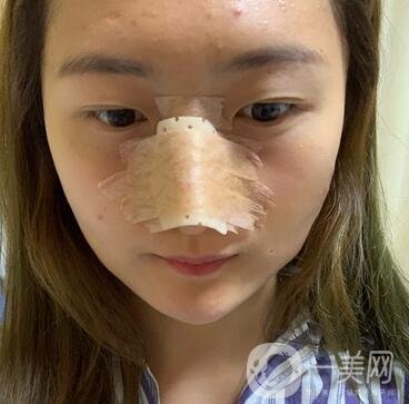 重慶新橋醫(yī)院整形科價格表，隆鼻案例分享