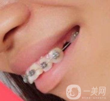 復(fù)旦大學(xué)附屬兒科醫(yī)院口腔科做牙齒矯正多少錢？價格表明細(xì)一覽