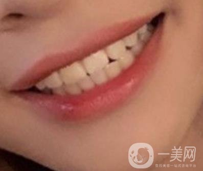 復(fù)旦大學(xué)附屬兒科醫(yī)院口腔科做牙齒矯正多少錢？價格表明細(xì)一覽
