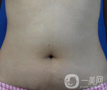 哈爾濱醫(yī)科大學(xué)附屬第一醫(yī)院整形科價(jià)格表和吸脂瘦肚子全新公布