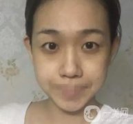 重慶醫(yī)科大學附屬第一醫(yī)院整形科價格價目表，附雙眼皮果圖