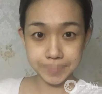 重慶醫(yī)科大學附屬第一醫(yī)院整形科價格價目表，附雙眼皮*果圖