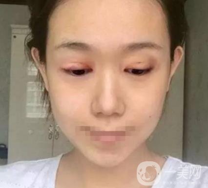重慶醫(yī)科大學附屬第一醫(yī)院整形科價格價目表，附雙眼皮*果圖
