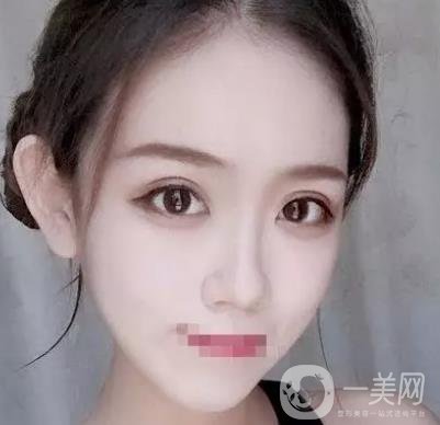 重慶醫(yī)科大學附屬第一醫(yī)院整形科價格價目表，附雙眼皮*果圖
