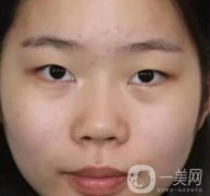 淮安第一人民醫(yī)院割雙眼皮怎樣？真人案例及整形價格表分享