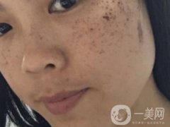 北京星美整形醫(yī)院祛斑如何？附案例和價格表