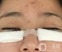 協(xié)和醫(yī)院整形美容科價格表，附去眼袋手術(shù)果圖分享
