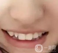 良鄉(xiāng)優(yōu)貝口腔醫(yī)院價格表，整牙恢復(fù)前后照