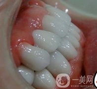 杭州格萊美醫(yī)院整牙價格表，看牙齒矯正術(shù)后果實(shí)拍