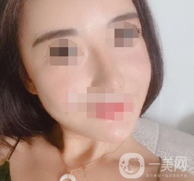 哈爾濱醫(yī)大二院整形美容科價(jià)格表上線，附*案例