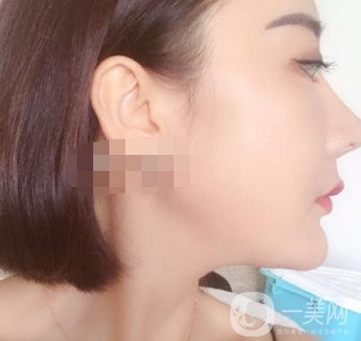 哈爾濱醫(yī)大二院整形美容科價(jià)格表上線，附*案例