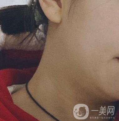 河南省人民醫(yī)院整形美容科價格表公布，附除腋臭案例