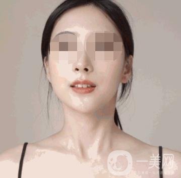 河南省人民醫(yī)院整形美容科價格表公布，附除腋臭案例