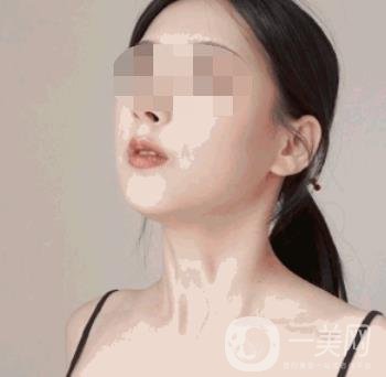 河南省人民醫(yī)院整形美容科價格表公布，附除腋臭案例