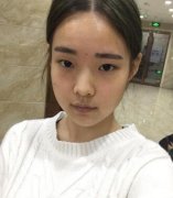 湖南湘雅醫(yī)院整形科價格表，附雙眼皮案例