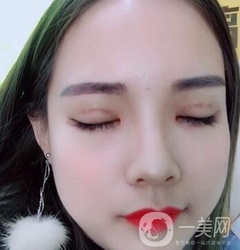 湖南第一醫(yī)院整形科價(jià)格表，附雙眼皮案例