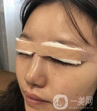 青島青醫(yī)附院整形價格表，還有雙眼皮實例