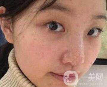 青島青醫(yī)附院整形價格表，還有雙眼皮實例