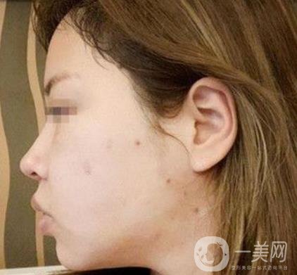 常州第一人民醫(yī)院*案例*果及整形價格表分享