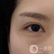 廣州人民醫(yī)院整形價格表，附去眼袋案例