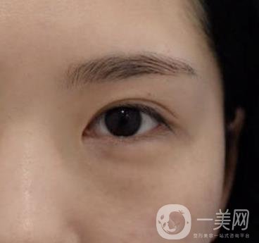 廣州人民醫(yī)院整形價格表，附去眼袋案例